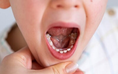 What to Expect Before, During, and After a Tooth Extraction